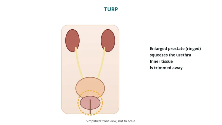 Urology guide diagram