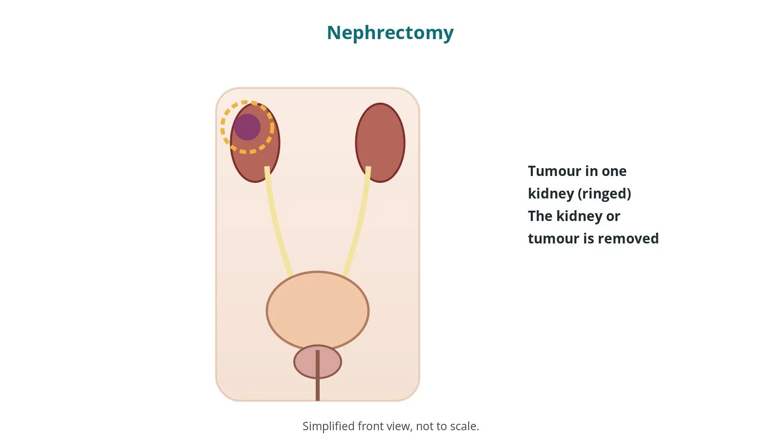 Nephrectomy (kidney removal): an OR 101 guide