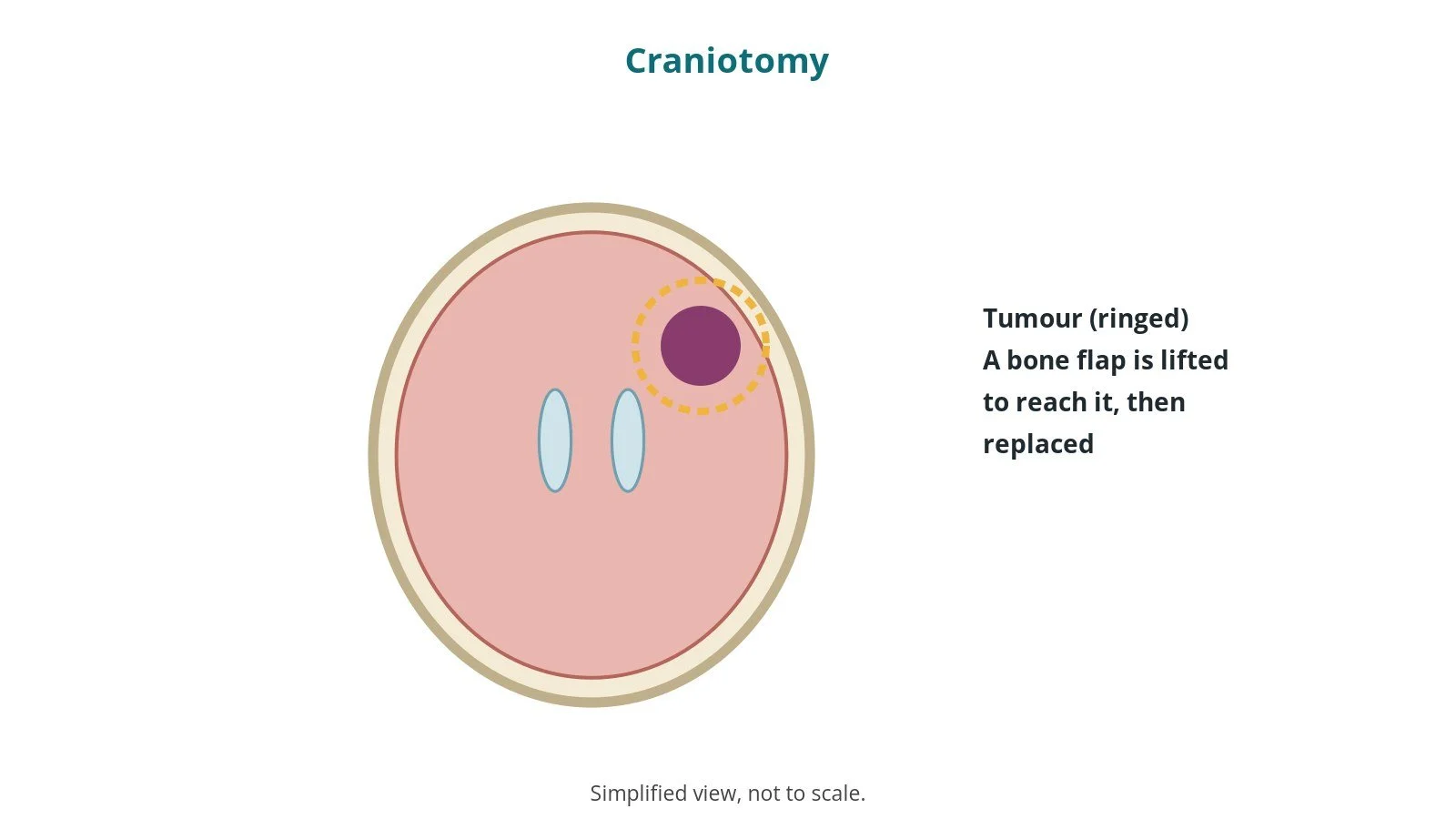 Craniotomy: an OR 101 guide