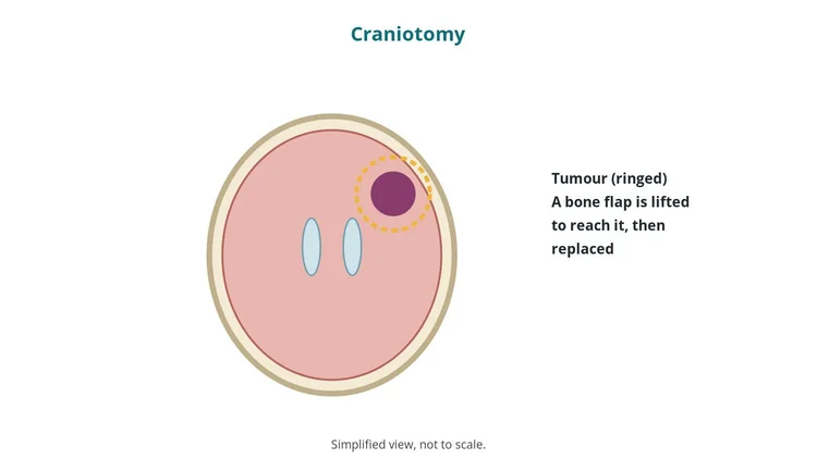 Neurosurgery guide diagram