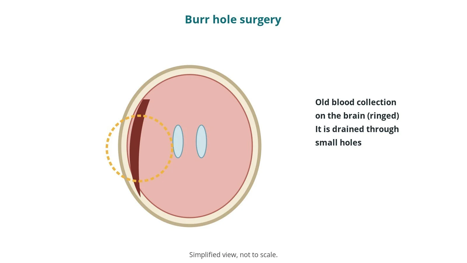 Burr hole surgery for chronic subdural haematoma: an OR 101 guide