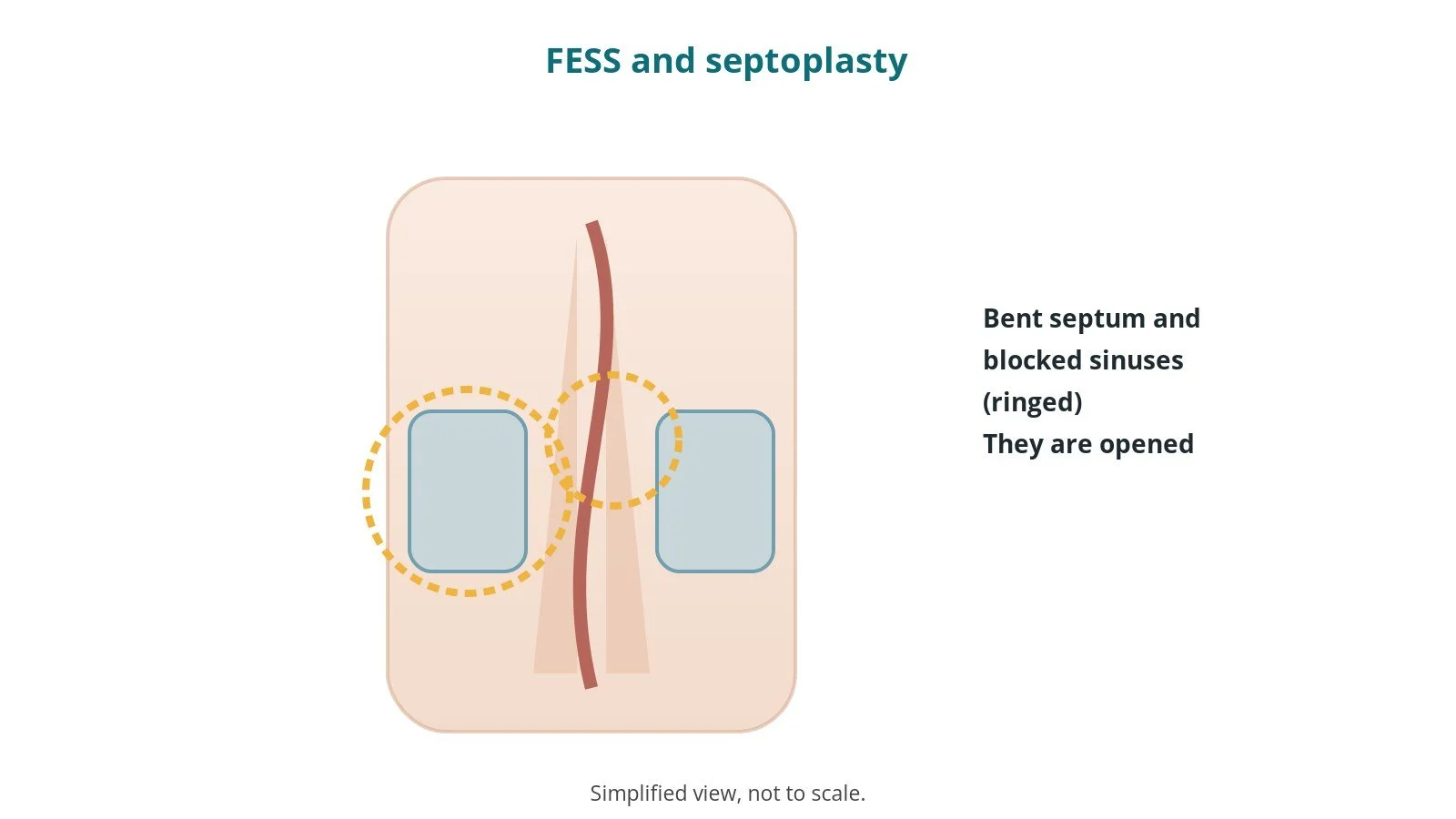FESS and septoplasty: an OR 101 guide