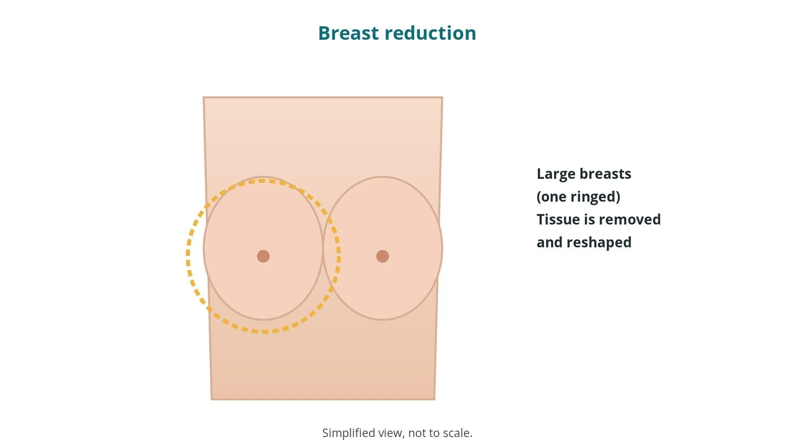 Breast reduction surgery: an OR 101 guide