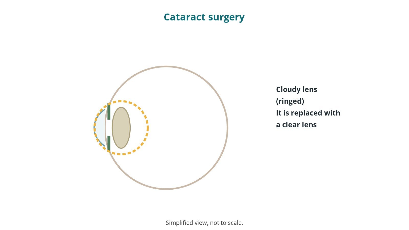 Cataract surgery (phaco and IOL): an OR 101 guide
