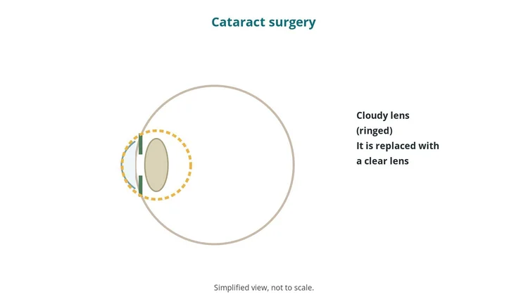 Ophthalmology guide diagram