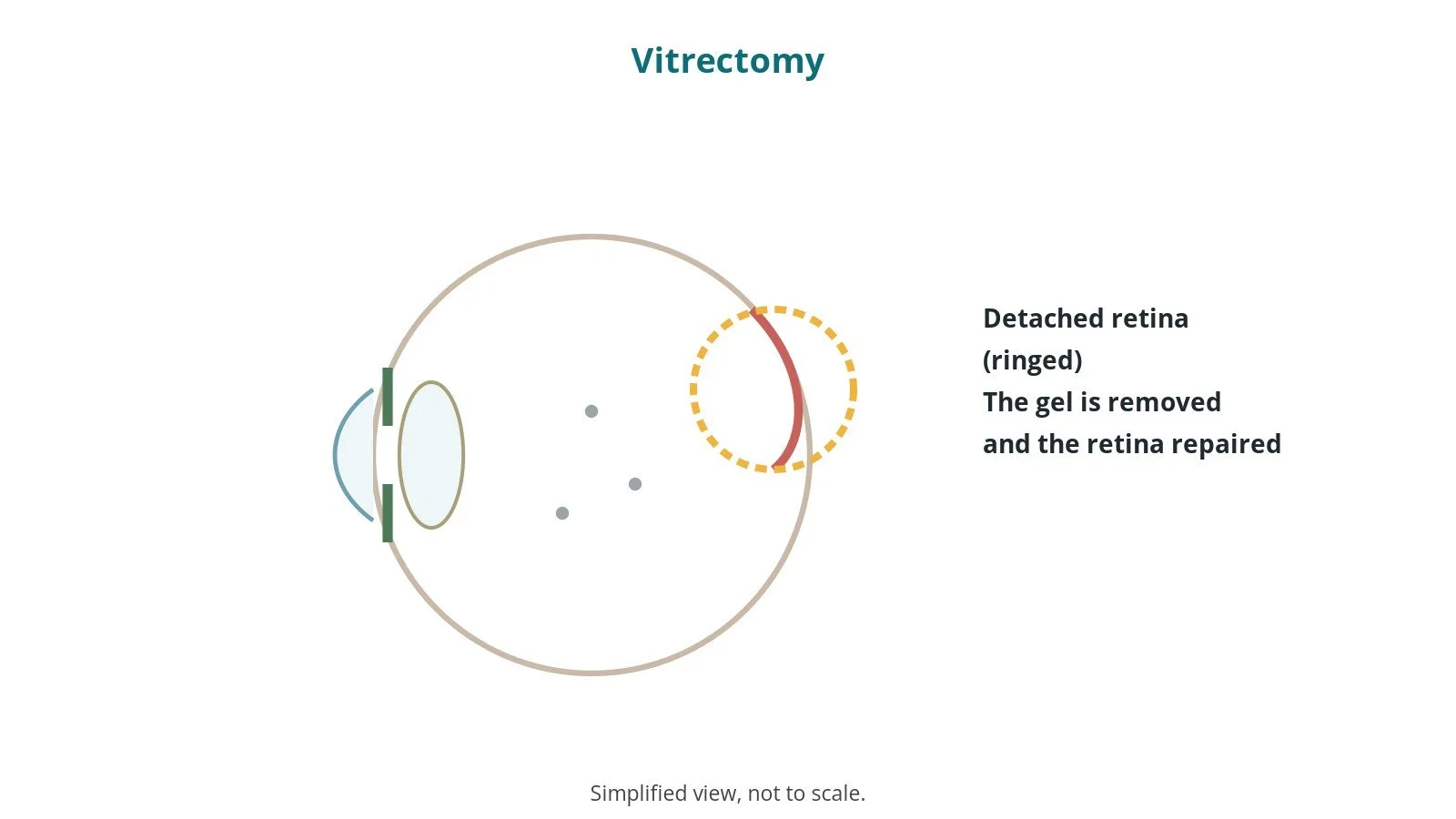 Vitrectomy: an OR 101 guide
