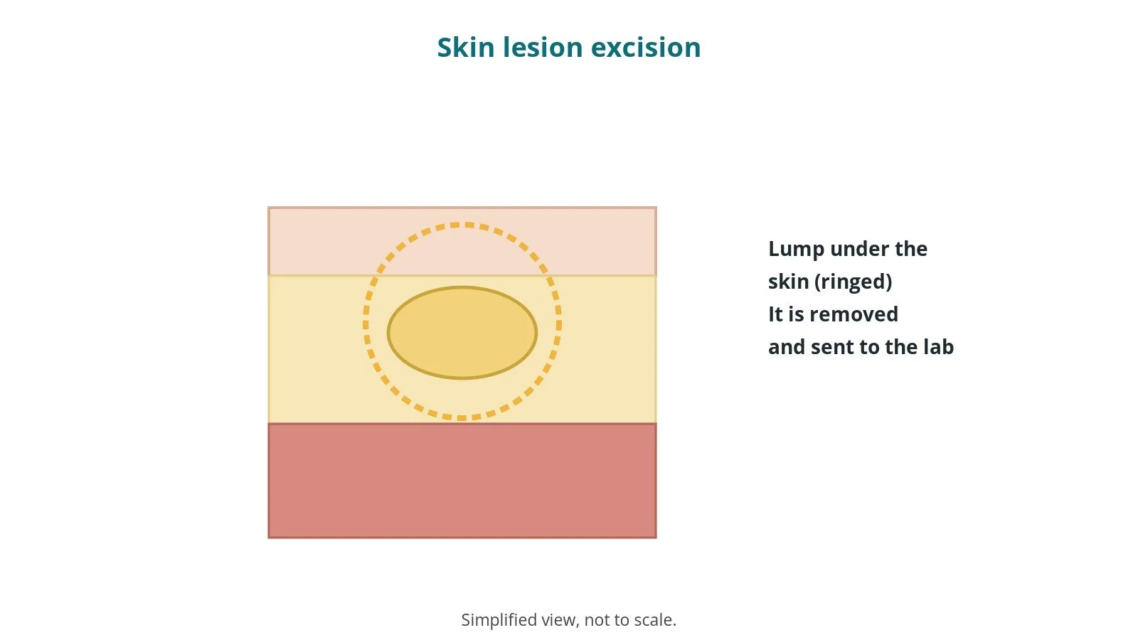 Skin lesion and lipoma excision: an OR 101 guide