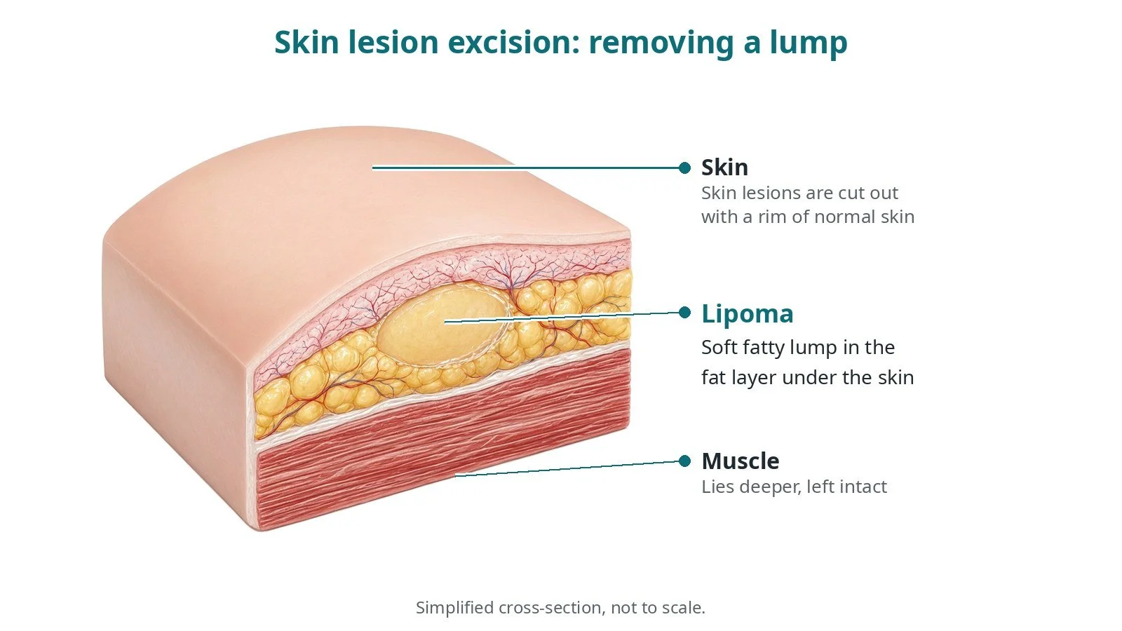 Skin lesion and lipoma excision: an OR 101 guide