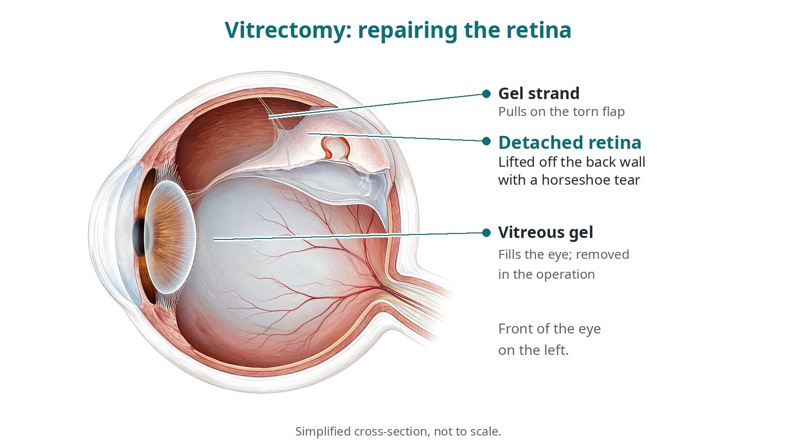 Vitrectomy: an OR 101 guide