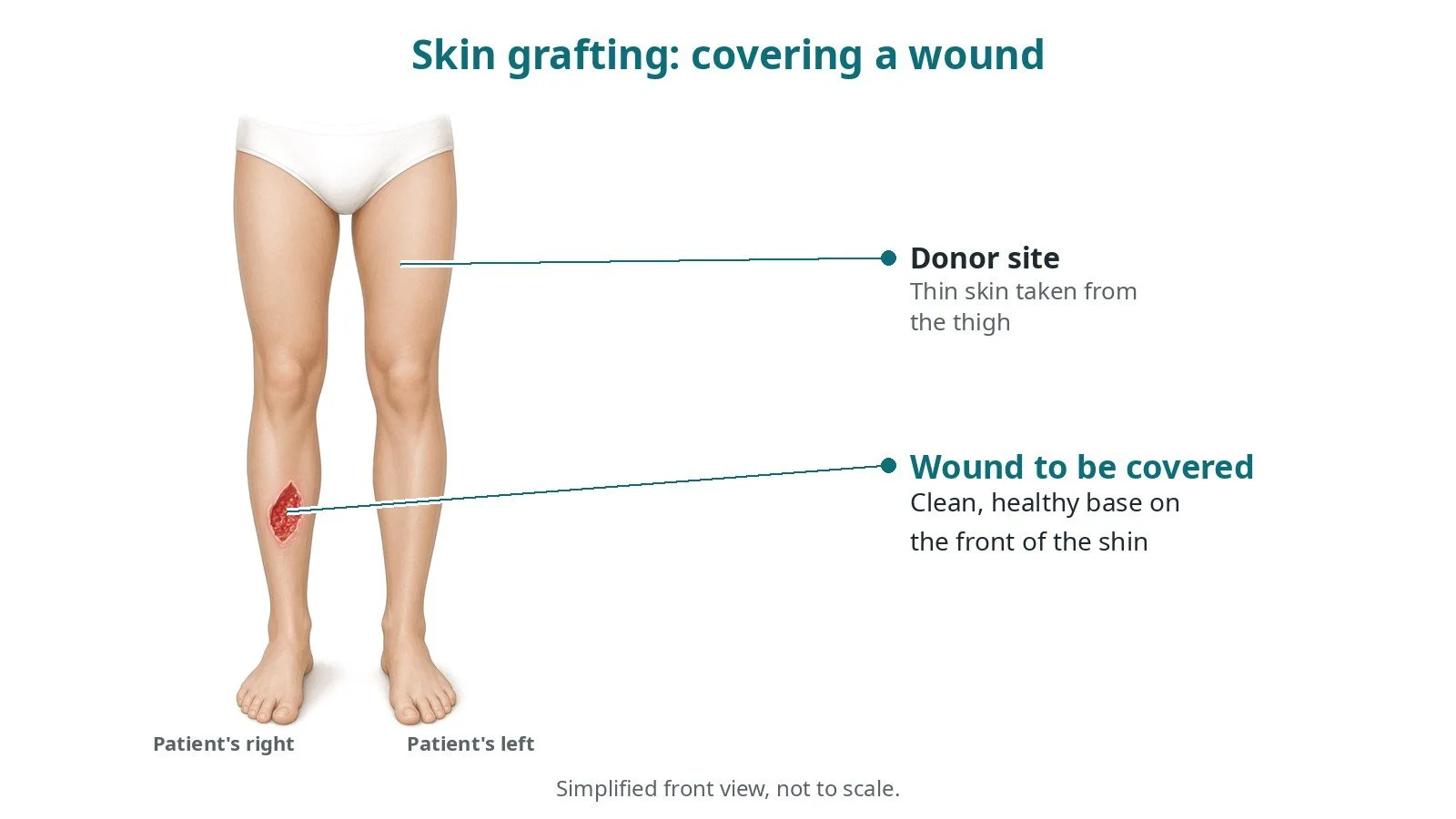 Skin grafting: an OR 101 guide