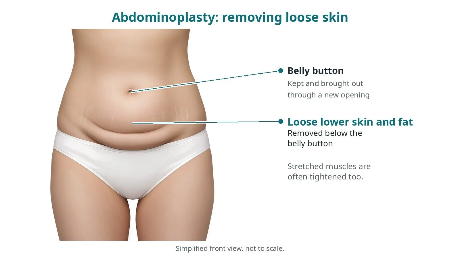 Abdominoplasty (tummy tuck): an OR 101 guide