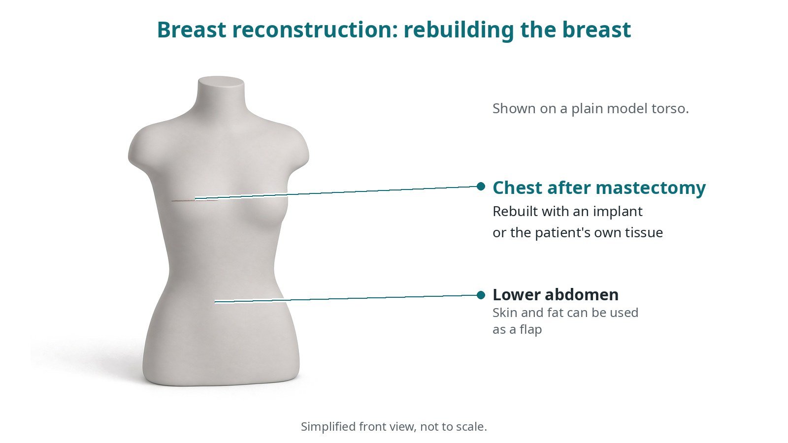 Breast reconstruction: an OR 101 guide