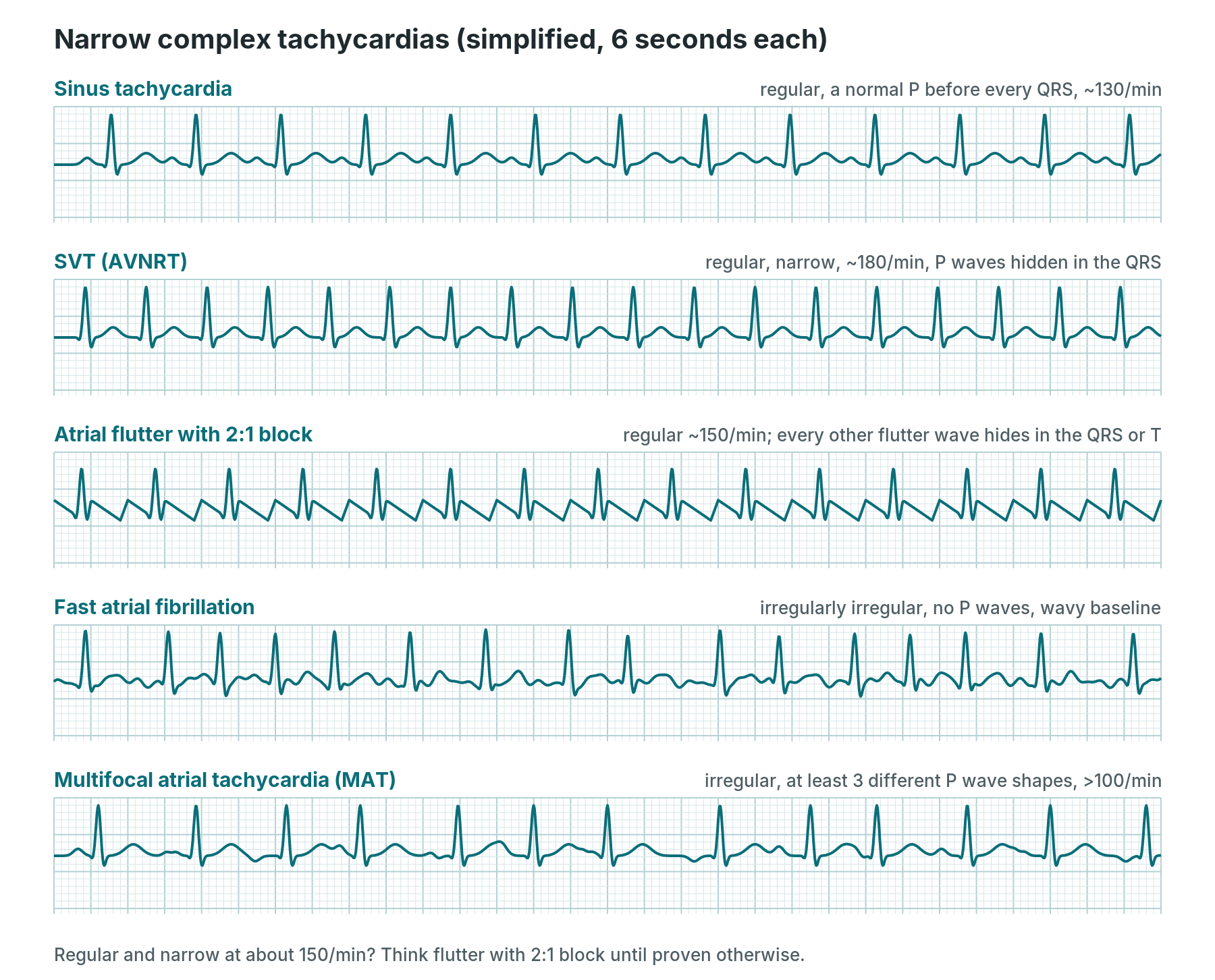 ECG advanced: a Cath Lab 101 guide