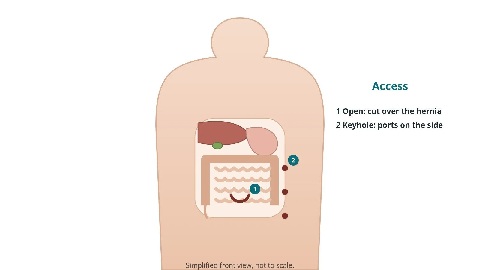Front view of a patient showing an incision over a belly button hernia and keyhole ports on the side of the abdomen