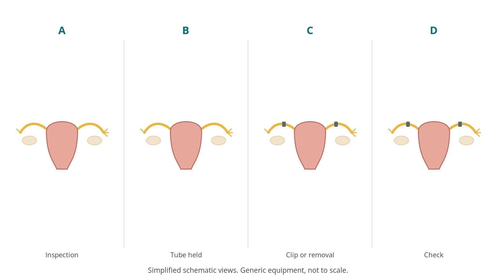 Four-panel schematic of tubal ligation: inspection, tube held, clip or removal, check