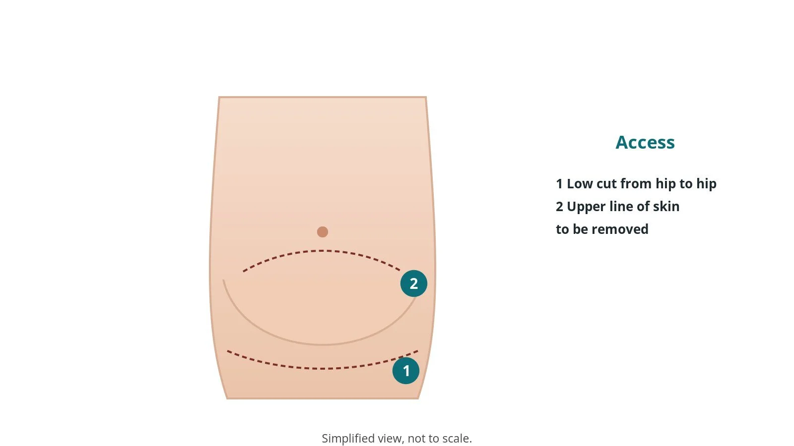 Diagram of the abdomen with a low hip-to-hip marking and an upper marking of the skin to be removed