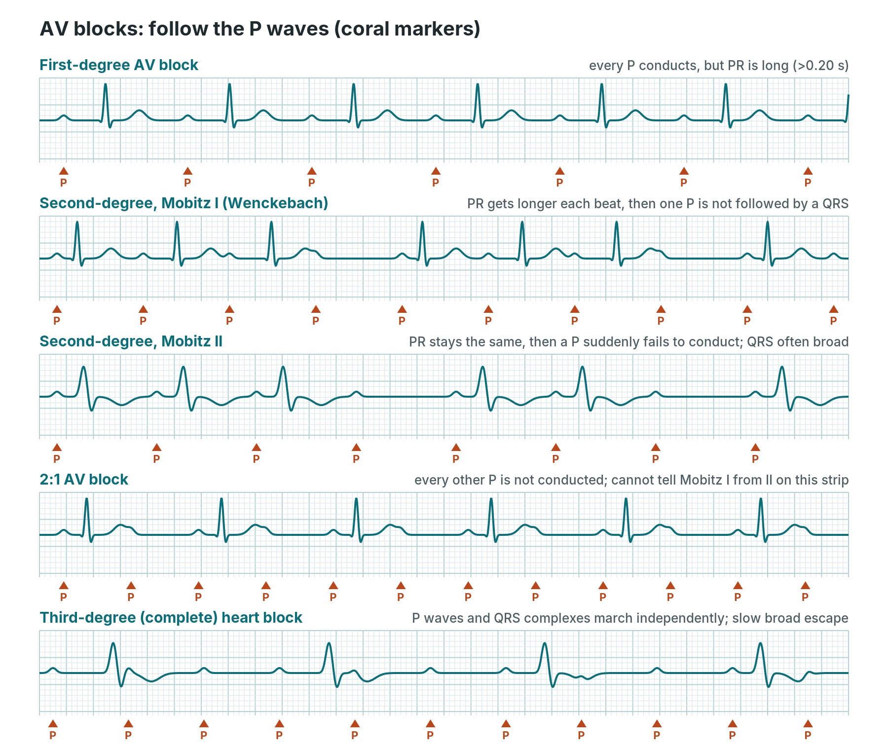 Five simplified strips of AV block with each P wave marked: first-degree, Mobitz I, Mobitz II, 2:1 block and complete heart block