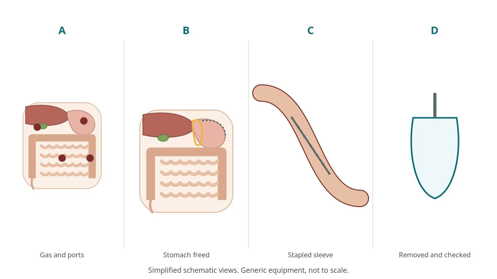 Four-panel schematic of sleeve gastrectomy: gas and ports, stomach freed, stapled sleeve, removed and checked