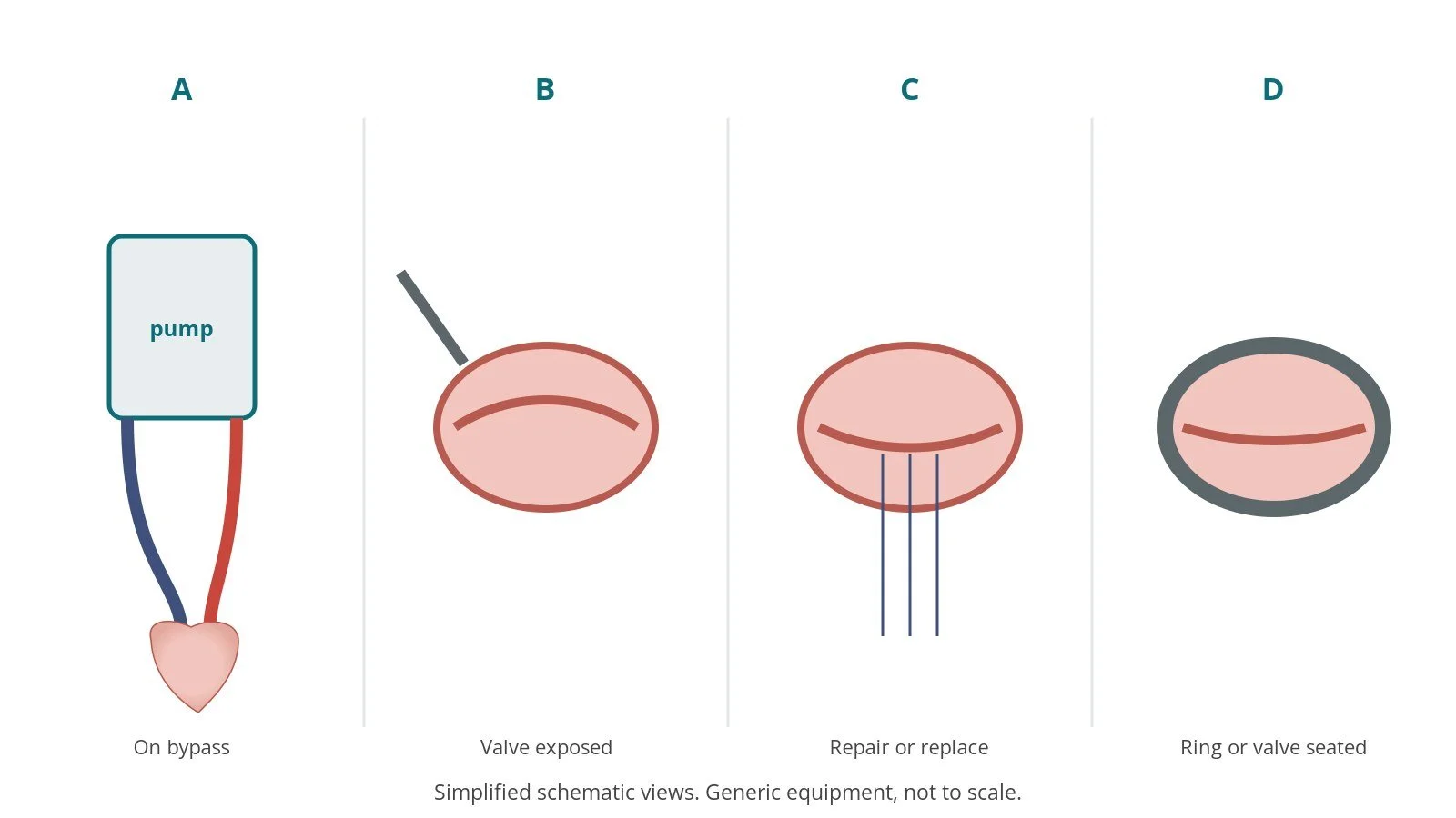 Four-panel schematic of mitral valve surgery: on bypass, valve exposed, repair or replace, ring or valve seated