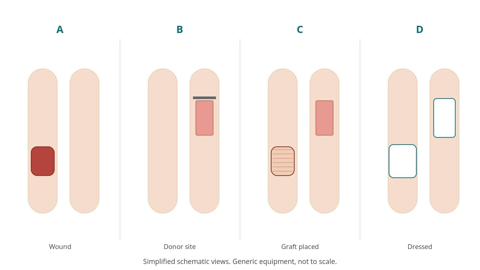 Four-panel schematic of skin grafting: wound, donor site, graft placed, dressed