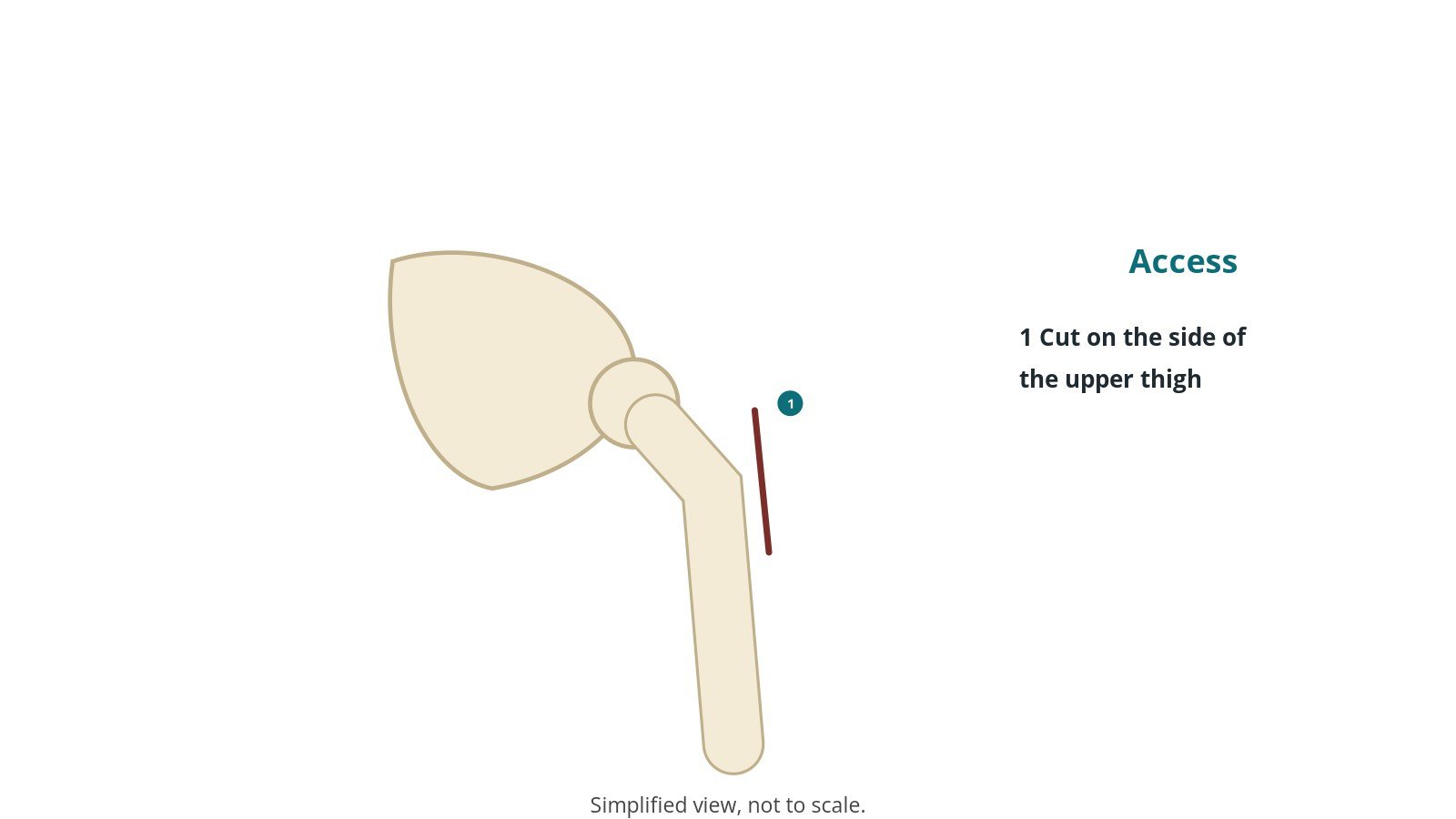 Diagram of the hip and thigh bone showing an incision on the side of the upper thigh