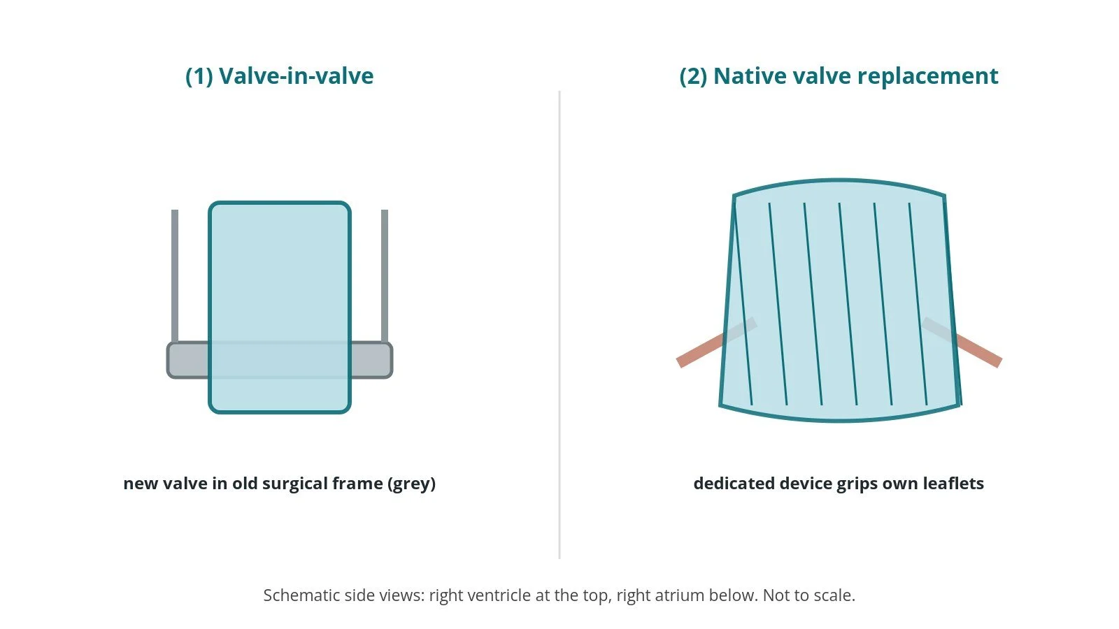 Two diagrams: a new valve expanded inside an old surgical tricuspid valve frame, and a dedicated device replacing a native leaking tricuspid valve