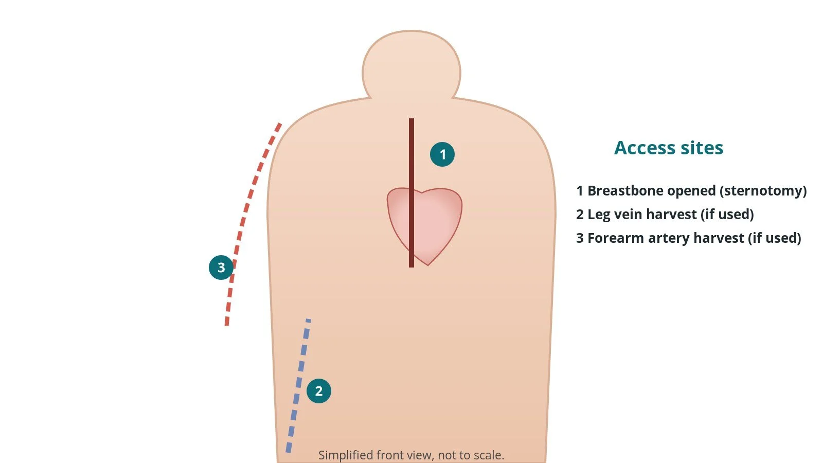 Front view of a patient showing the breastbone incision and the leg vein and forearm artery harvest sites
