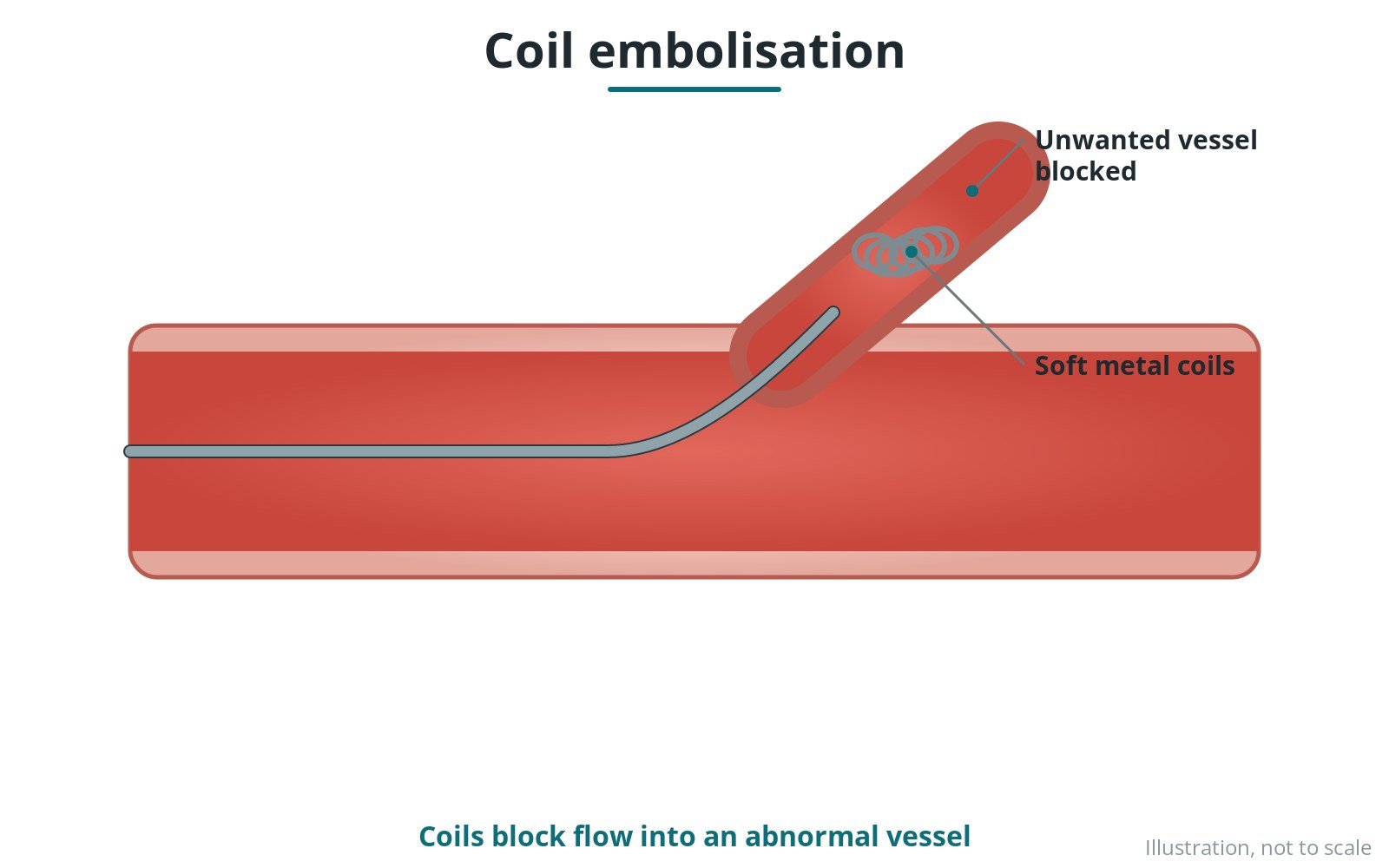 Diagram of small metal coils packed inside a blood vessel to block it