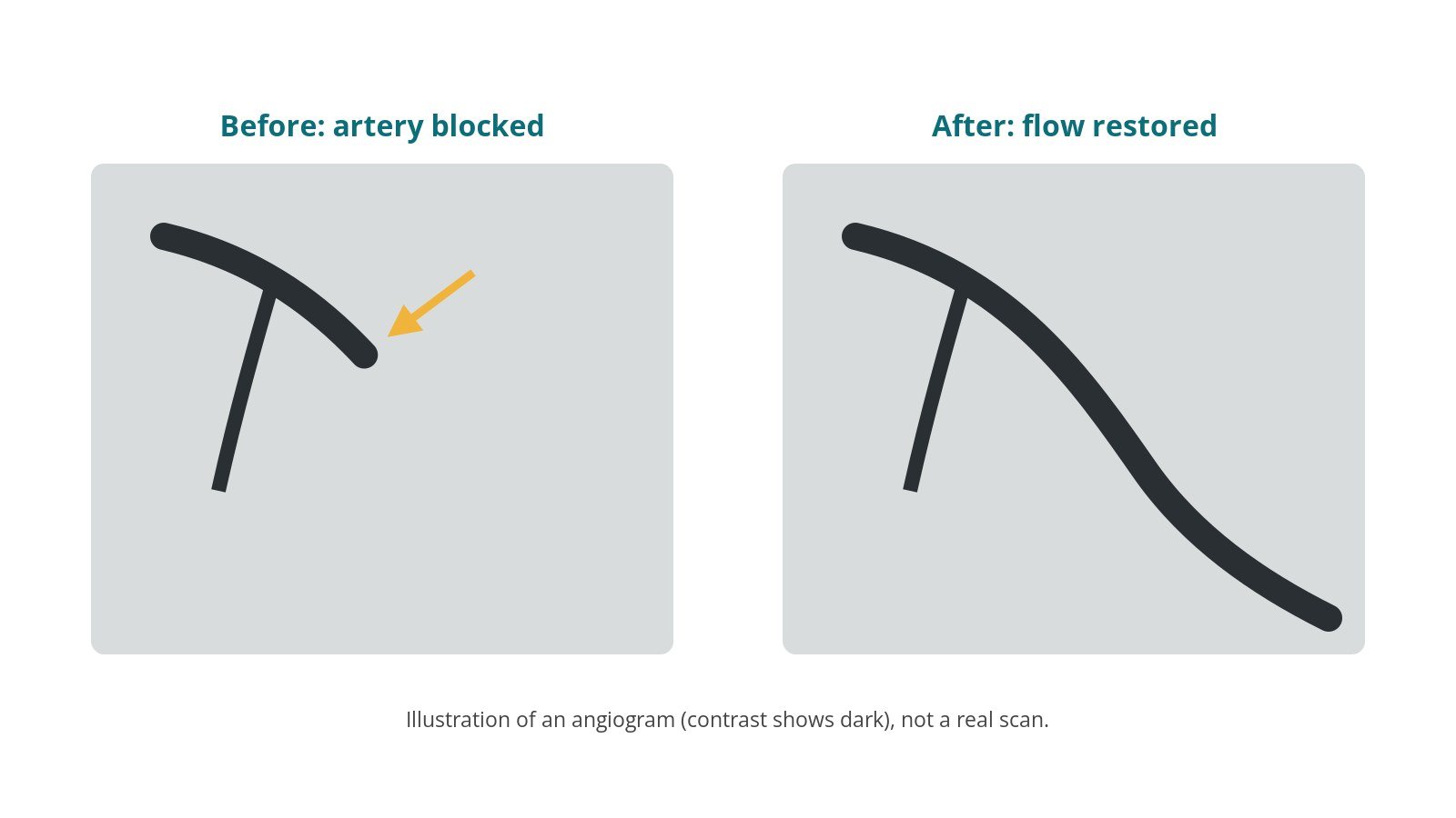 Illustration of a blocked coronary artery on an angiogram before treatment, and the same artery fully filled with contrast after a stent