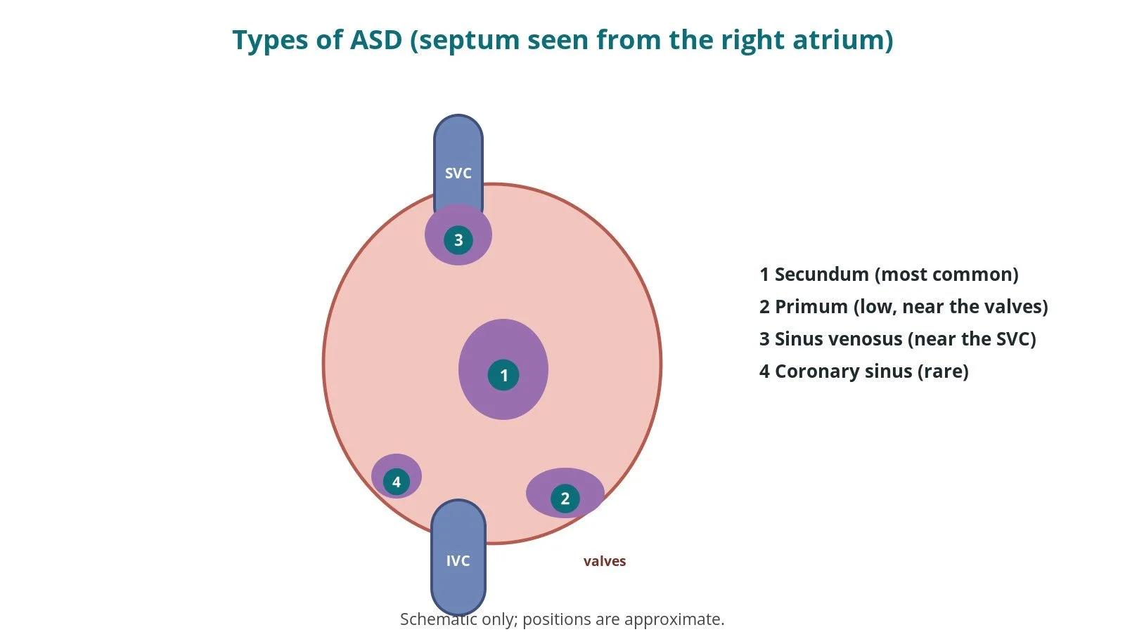 Diagram of the atrial septum seen from the right atrium, showing where secundum, primum, sinus venosus and coronary sinus defects occur