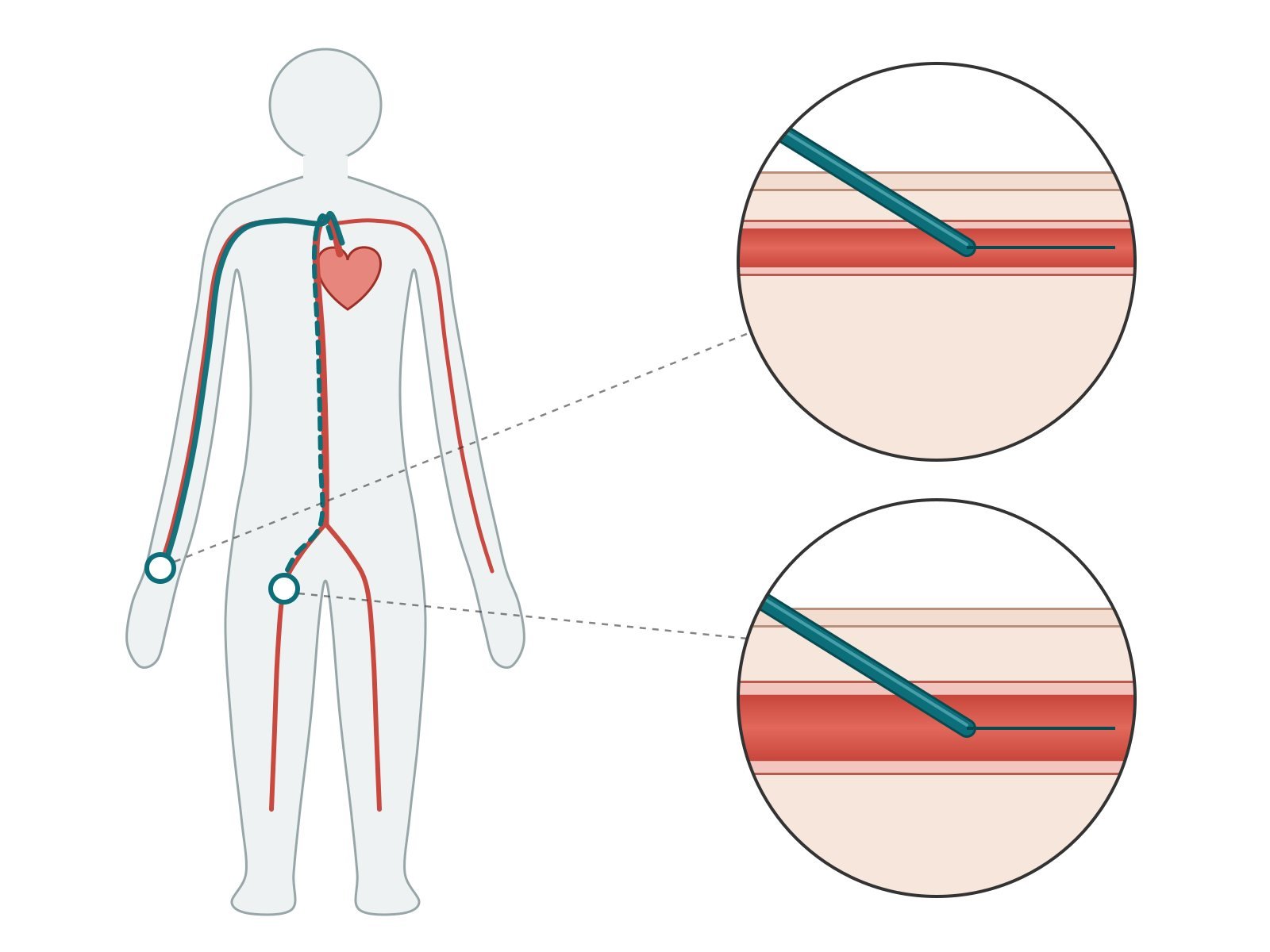 Diagram 2: wrist (radial) and groin (femoral) access routes for PCI