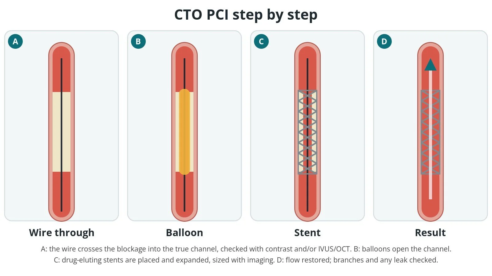 Four-panel diagram of CTO PCI: a wire across the blockage, a balloon opening the channel, a stent placed, and the artery open with flow restored