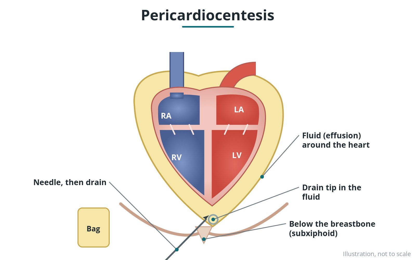 Diagram of a needle from below the breastbone into fluid around the heart, with a drain