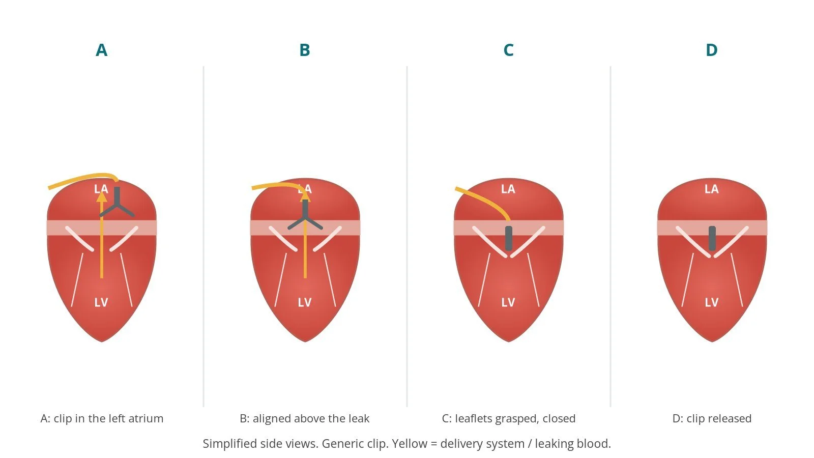 Step-by-step diagram of mitral TEER: position above the leak, grasp the leaflets, close and release the clip