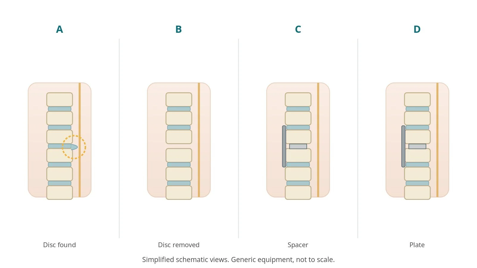 Four-panel schematic of ACDF: disc found, disc removed, spacer, plate