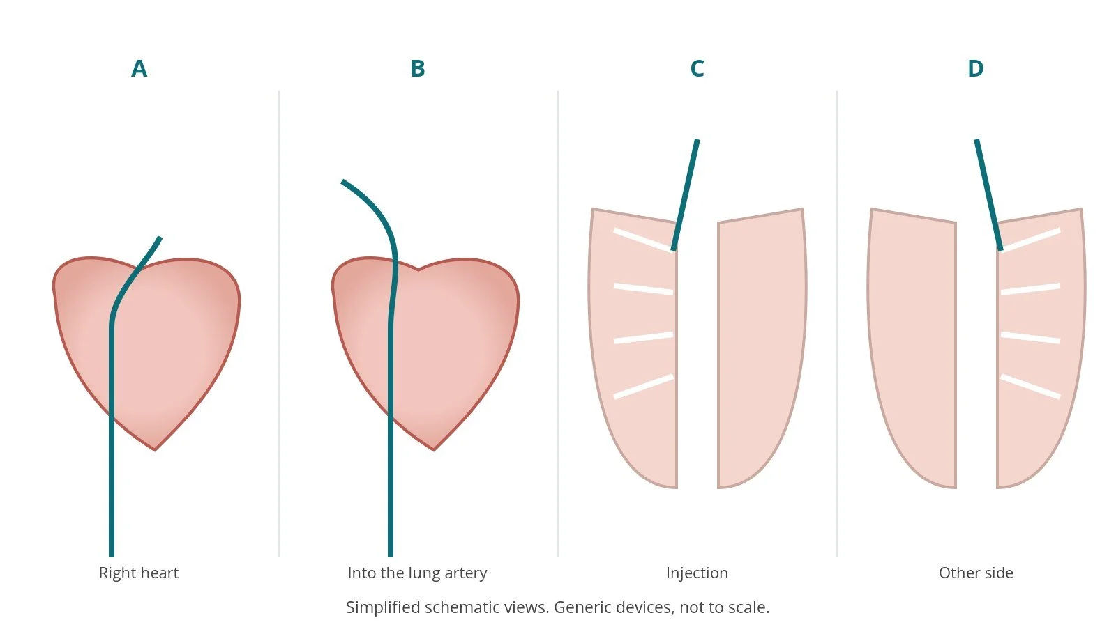 Four-panel schematic of pulmonary angiography: right heart, into the lung artery, injection, other side
