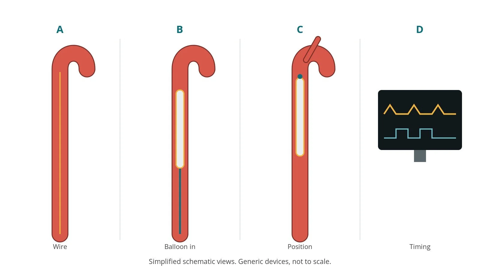 Four-panel schematic of intra-aortic balloon pump insertion: wire, balloon in, position, timing