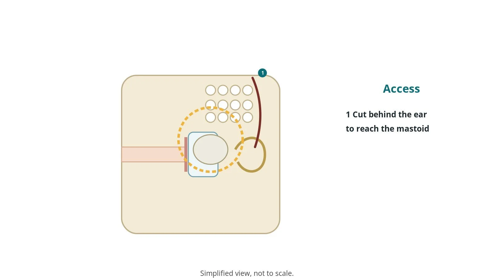 Diagram of the ear canal, eardrum, middle ear and mastoid bone with disease ringed and an incision marked