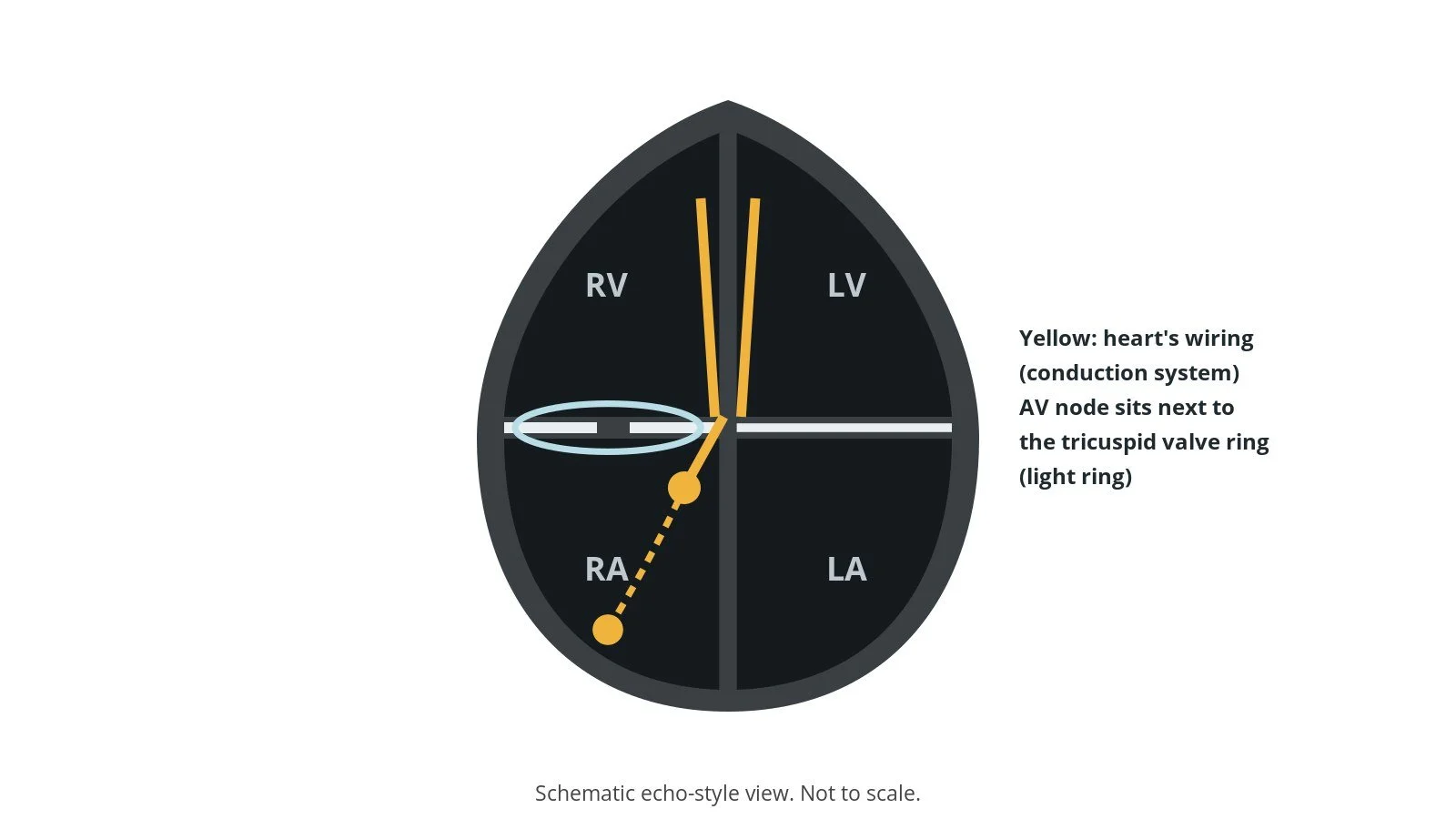 Diagram of the heart's conduction system near the tricuspid valve, showing why a new valve can cause heart block