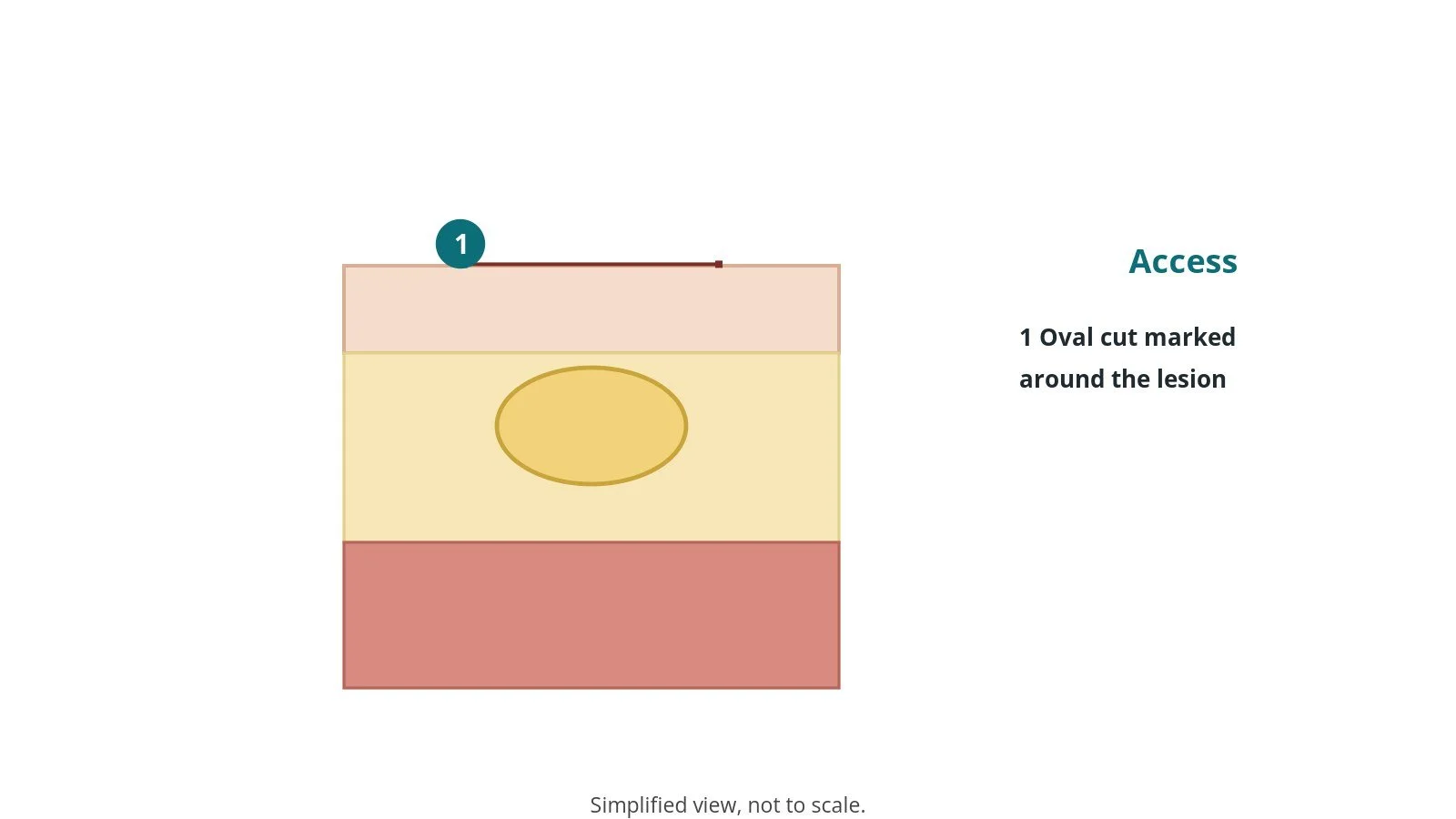 Cross-section diagram of skin and fat with a lump under the skin and the planned oval cut marked on the skin surface
