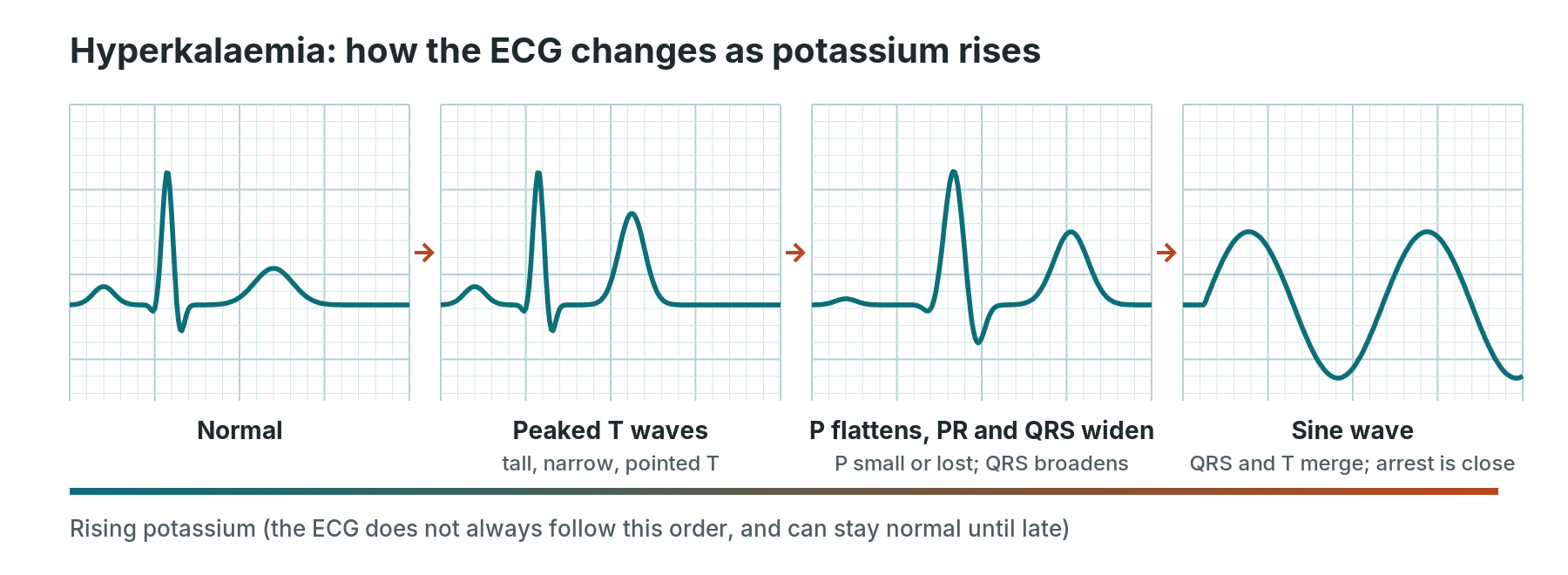 Four simplified beats showing hyperkalaemia progression: normal, peaked T waves, flattened P with wide QRS, and sine wave