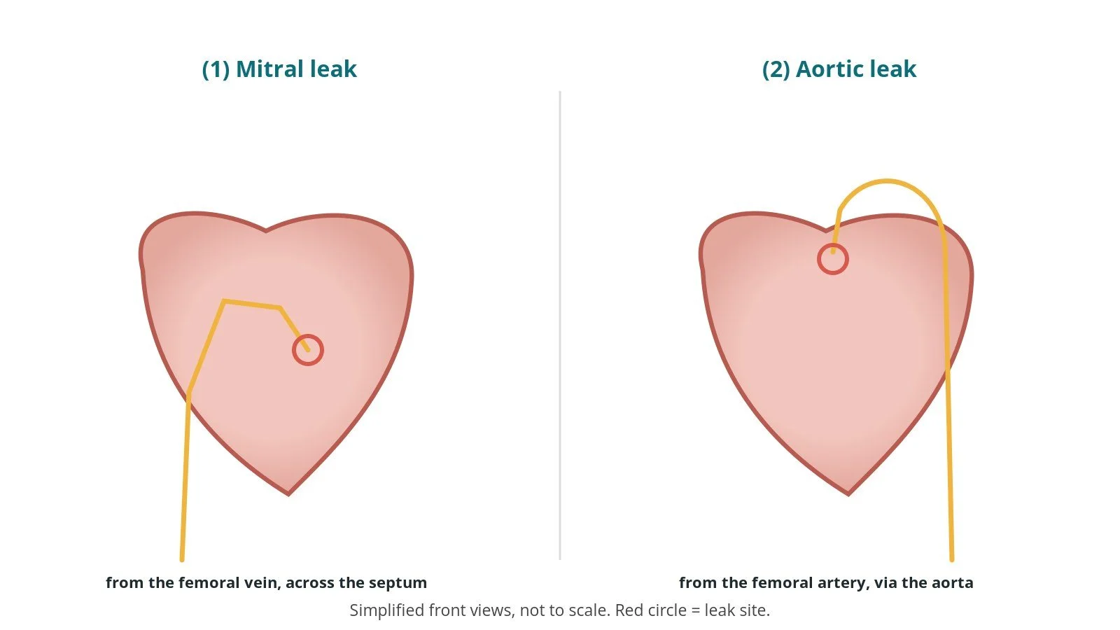 Two diagrams: a catheter crossing the atrial septum to reach a leak around a mitral valve, and a catheter coming down the aorta to reach a leak around an aortic valve