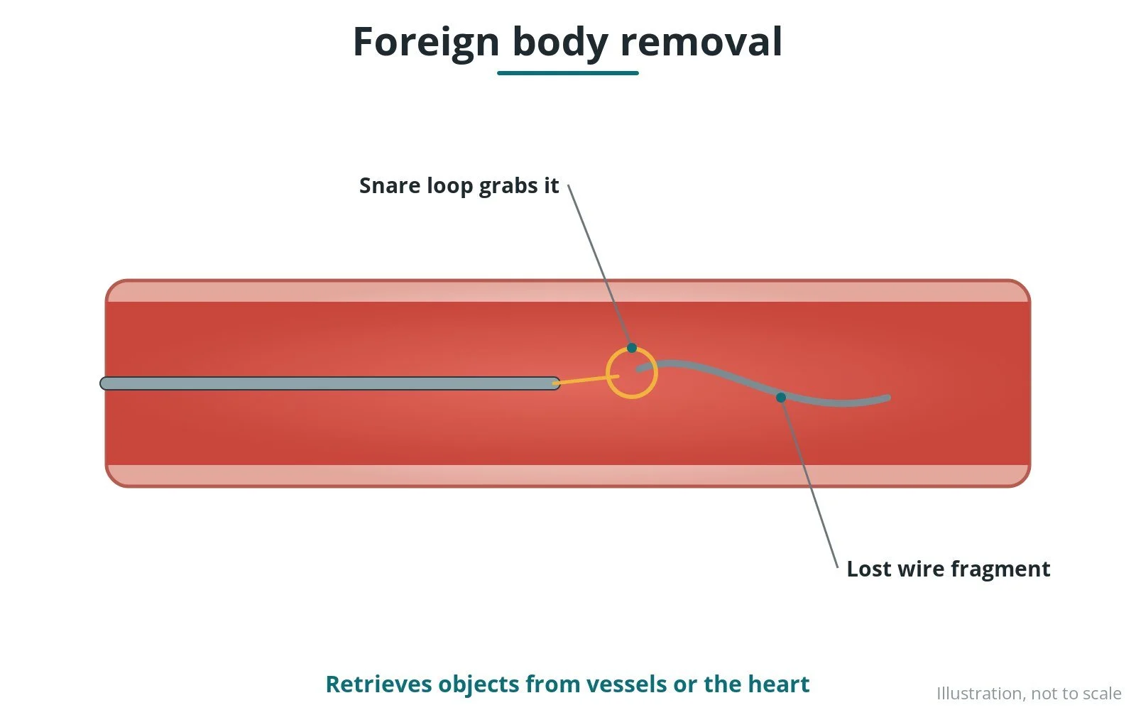 Diagram of a wire loop snare catching a fragment inside a blood vessel