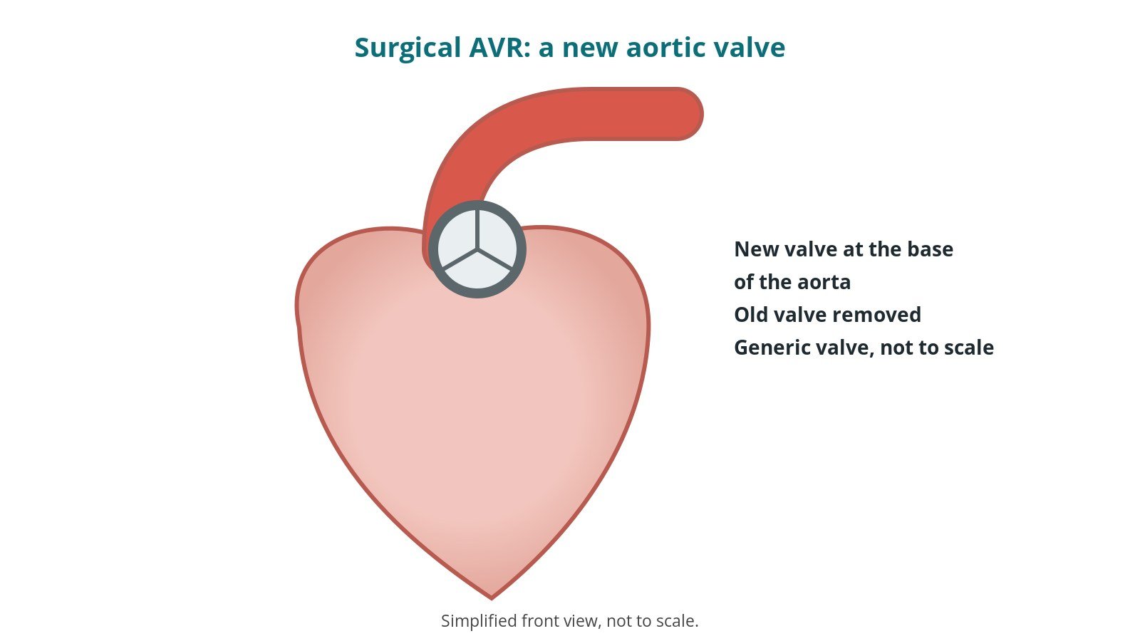 Diagram of the heart showing a new prosthetic valve sewn into the aortic valve position at the base of the aorta