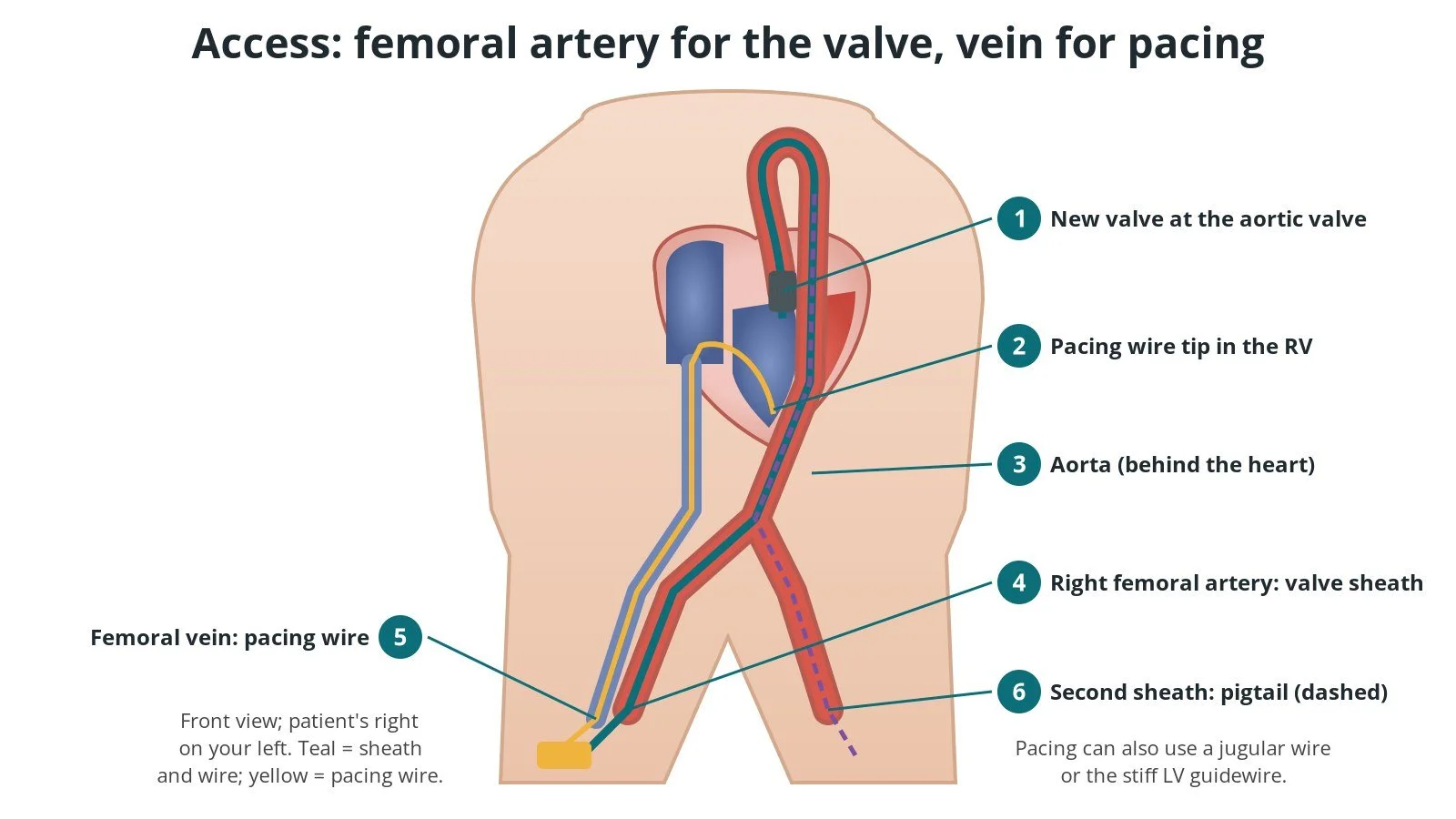 Front view of a patient showing a valve delivery sheath and wire passing from the right femoral artery up the aorta to the aortic valve, a temporary pacing wire from the femoral vein to the right ventricle, and a second sheath for a pigtail catheter