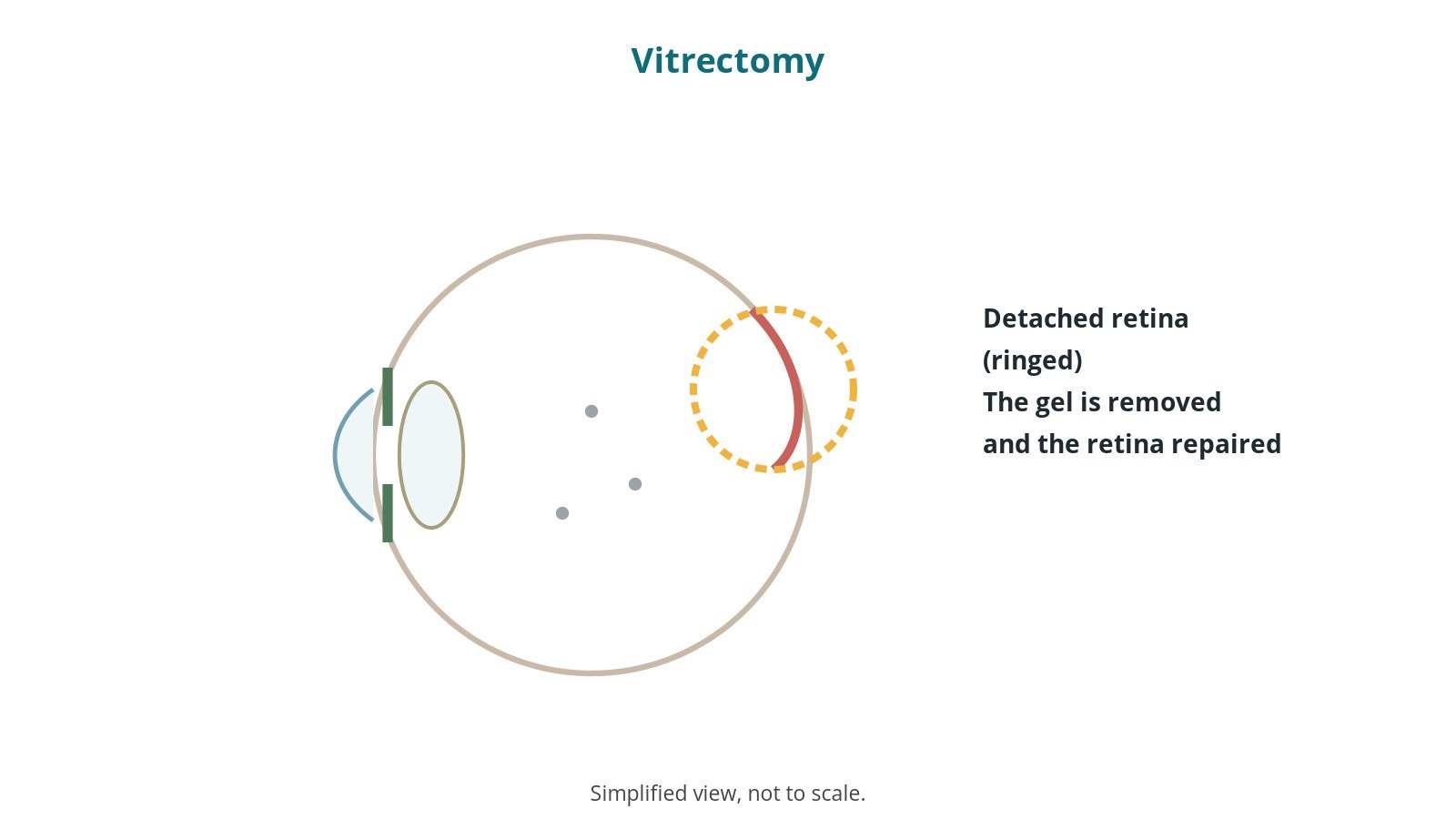 Simplified side-view diagram of the eye with a detached area of retina at the back, ringed