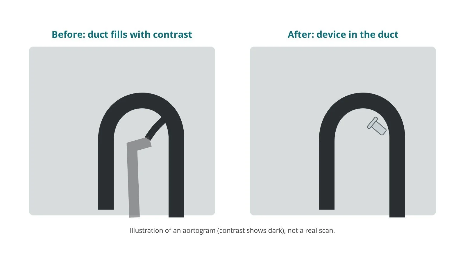 Illustration of an aortogram before closure with contrast passing through the duct into the pulmonary artery, and after closure with the duct blocked by a device