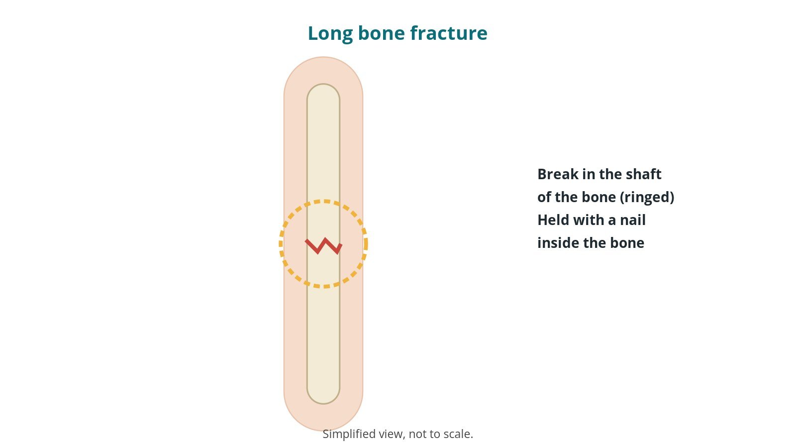 Diagram of a leg bone with a break across the shaft, ringed