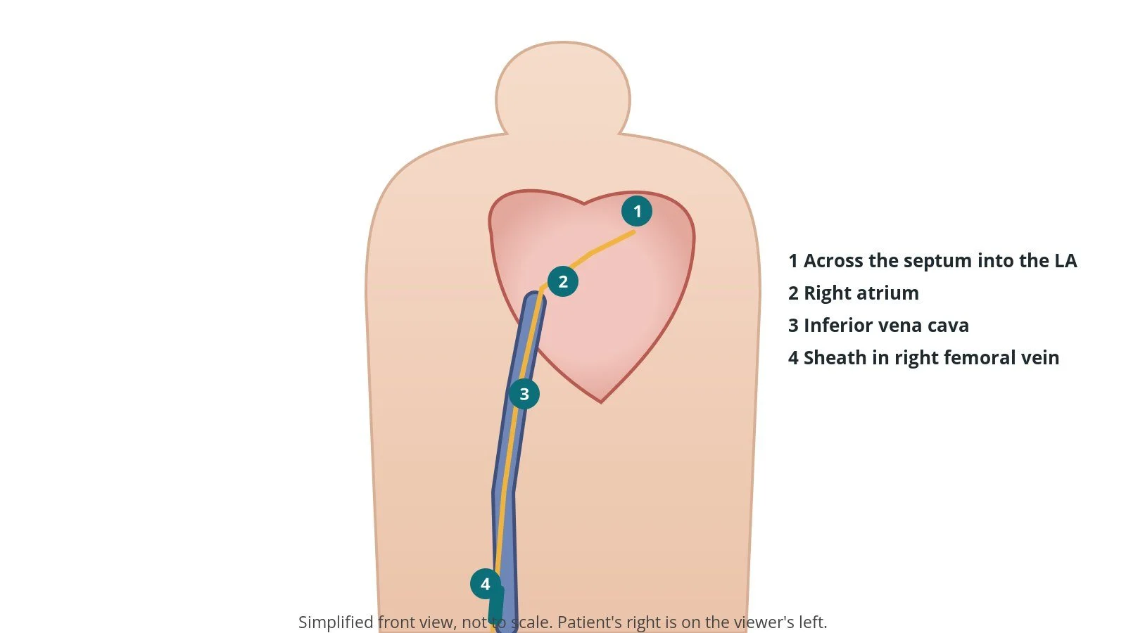 Front view of a patient showing a catheter from the right femoral vein up to the right atrium and across the atrial septum into the left atrium