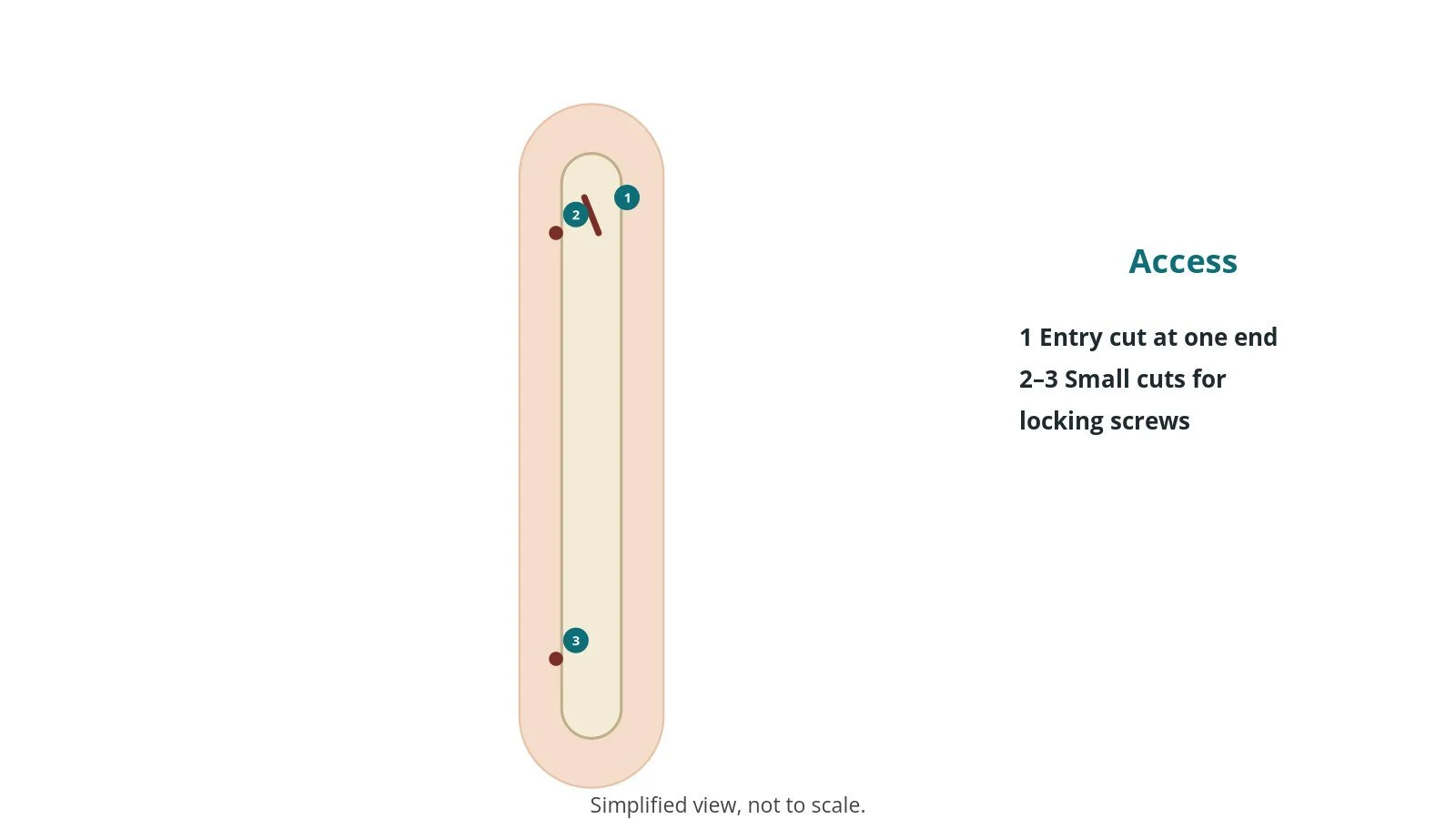 Diagram of a long bone in the leg showing a small entry cut at one end and small cuts for locking screws